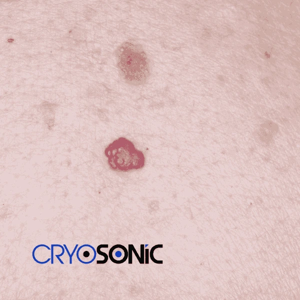 Looking for pain free cherry angioma removal treatment Thame? Call our team today! Thame