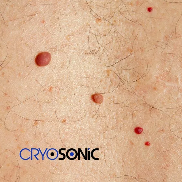 get cherry angioma removal treatment today! Thame