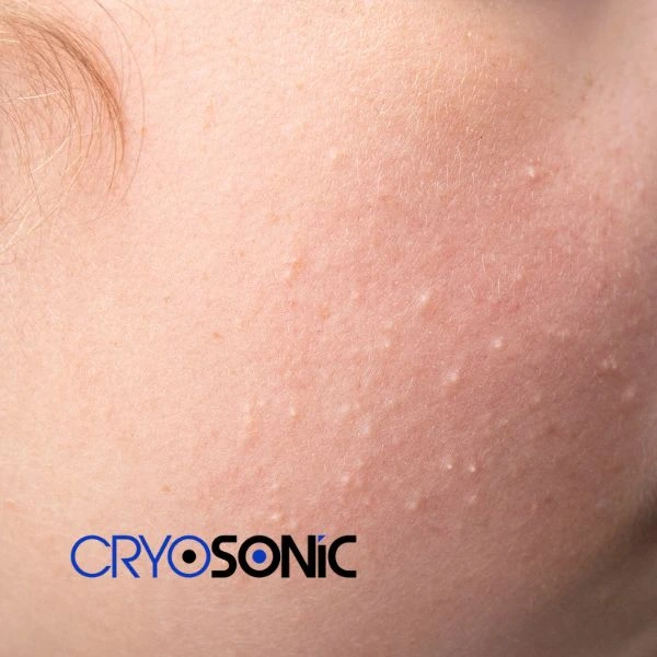 Are you looking for milia removal treatment? Contact our team today Thame