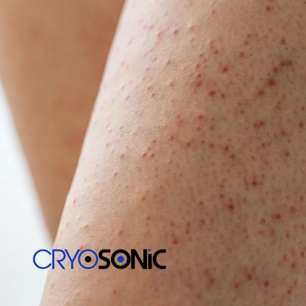 Looking for Seborrhoeic Keratosis removal Thame treatment? Call our consultants today in Thame