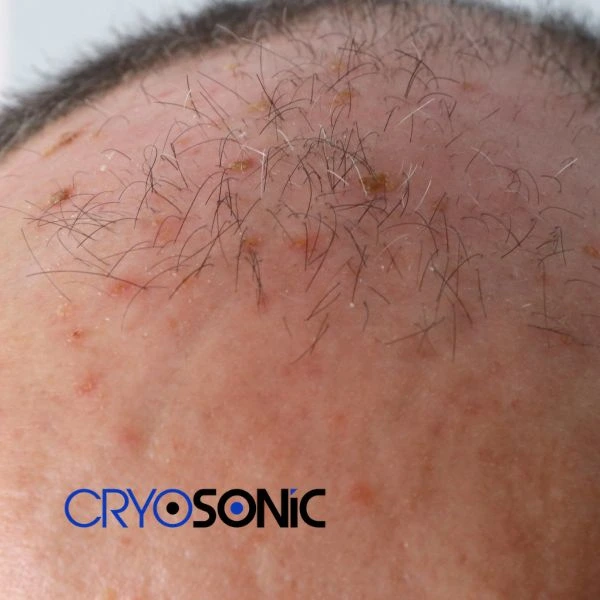 Access Seborrhoeic Keratosis removal from the comfort of your own home! Call us today in Thame
