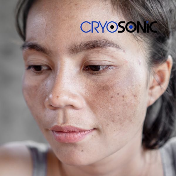 Ready to start age spots removal? Contact our team today in Thame