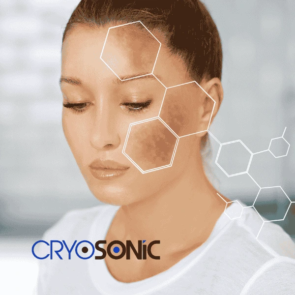 Are you looking for age spot removal treatment? Contact Cryosonic today in Thame