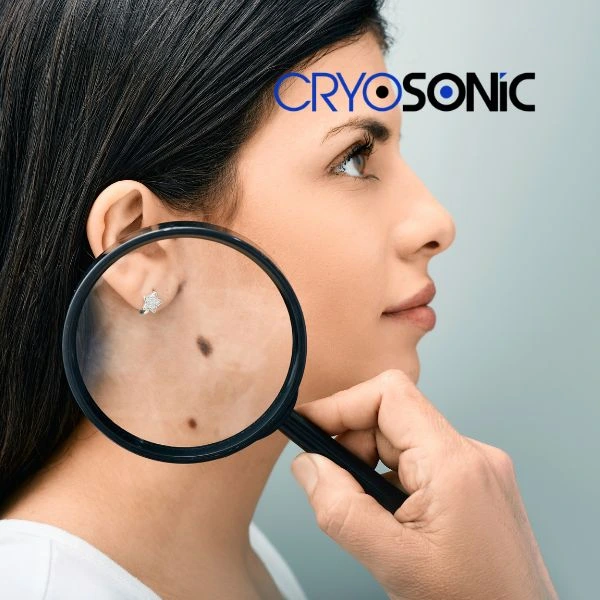 Do you want to learn more about benign moles removal treatment? Call our team today Thame