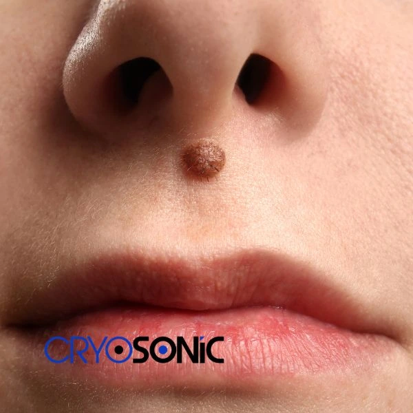 Start your benign moles removal treatment today Thame