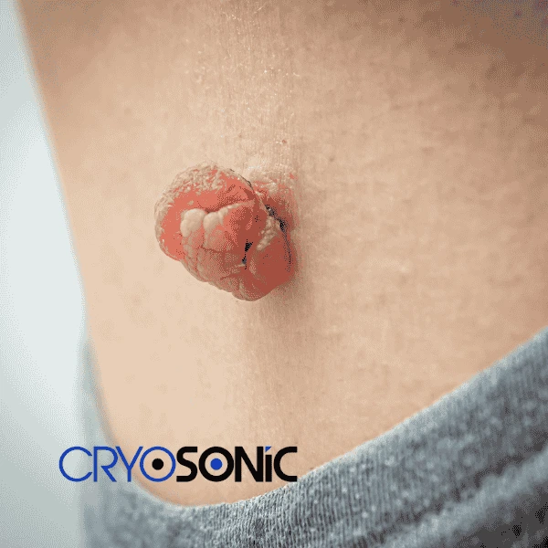 Book your skin tags removal Thame from comfort of your own home! Thame