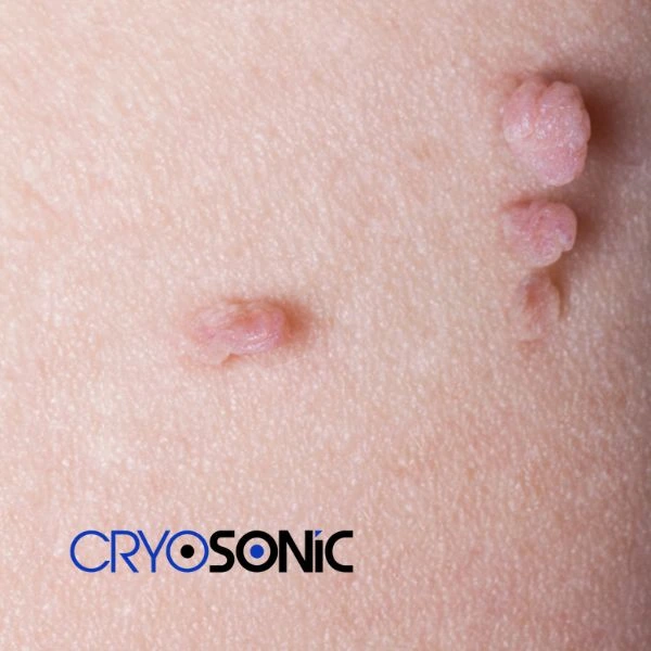 Are you looking for fast effect skin tag removal Thame? Book in NOW! Thame