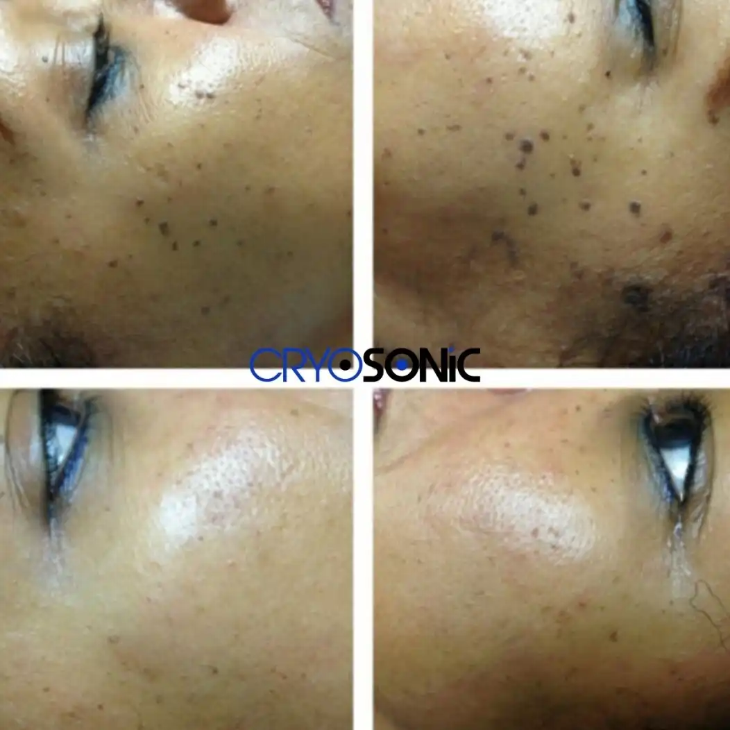 Why Skin Shows Pigmentation After Treatment Thame