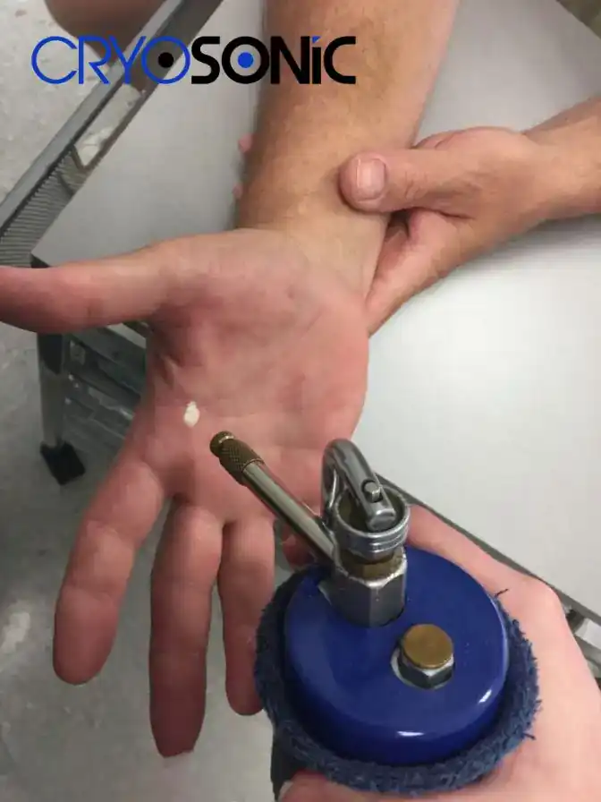 Temperature Differences: OTC vs Medical-Grade Cryotherapy Thame